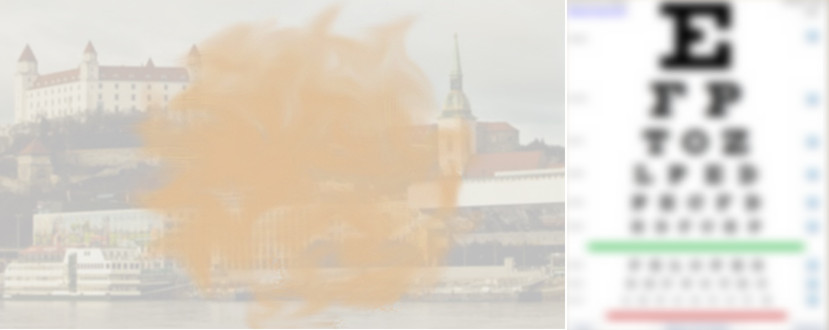 Šedý zákal – katarakta senilis obr. 2 Šedý zákal – katarakta senilis obr. 2